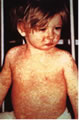 Picture of child with measles