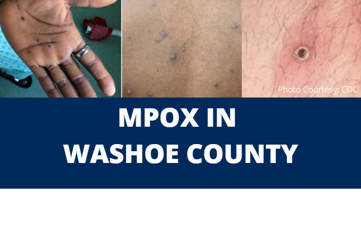 Monkeypox information in Washoe County